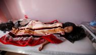 A girl lies on a bed at a hospital where she is receiving treatment for cholera amid confirmation by the UNICEF and the World Health Organization of an outbreak of the epidemic in Sanaa, the capital of Yemen October 11, 2016. REUTERS/Khaled Abdullah