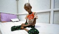 Saida Ahmad Baghili, 18, who is affected by severe acute malnutrition, sits on a bed at the al-Thawra hospital in the Red Sea port city of Houdieda, Yemen October 24, 2016. (REUTERS/Abduljabbar Zeyad)