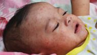 FILE PHOTO: A baby with measles in hospital in Manila, the Philippines, in early 2014. (Photo courtesy: Jim Goodson, M.P.H. / CDC) 