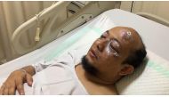 This handout picture taken on April 11, 2017 and released by the Indonesian Police shows Novel Baswedan, a prominent Indonesian corruption investigator, as he gets treatment at a hospital in Jakarta. AFP PHOTO / INDONESIAN POLICE