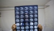 A cancer patient poses with CT scan images of his intestine at a hotel room where he stays near the Peking Union hospital in Beijing, April 6, 2016. Reuters/Kim Kyung-Hoon