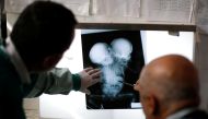FILE PHOTO: Doctors check the x-ray film of newly born conjoined twins at the child intensive care unit of al-Thawra hospital in Sanaa, Yemen, February 6, 2019. Reuters/Khaled Abdullah