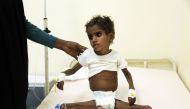 Malnourished Yemeni child receiving treatment. File photo for representational purposes only.