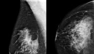 A yellow box indicates where an artificial intelligence (AI) system found cancer hiding inside breast tissue, in an undated photo released by Northwestern University in Chicago January 1, 2020. Northwestern University/Handout via Reuters