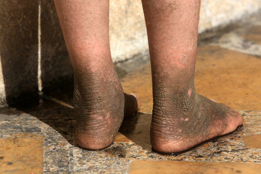 The skin on five-year-old Doaa's feet is blackened after a rocket fired by Islamic State landed and exploded in Qayyara, Iraq, November 12, 2016. REUTERS/Air Jalal
