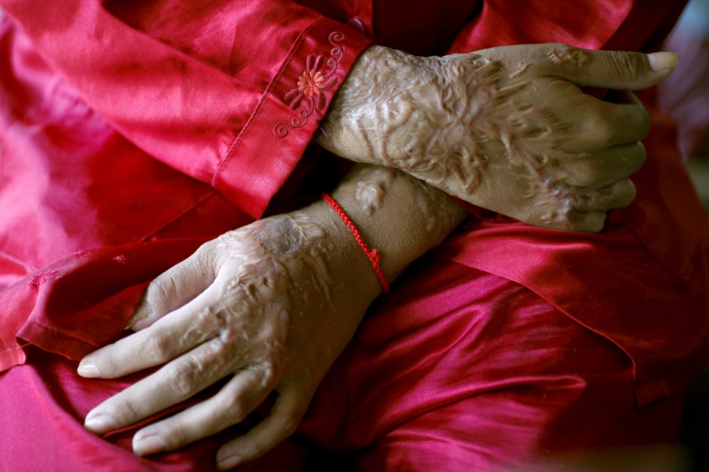 Representative image of an acid attack victim (Reuters / Damir Sagolj) 