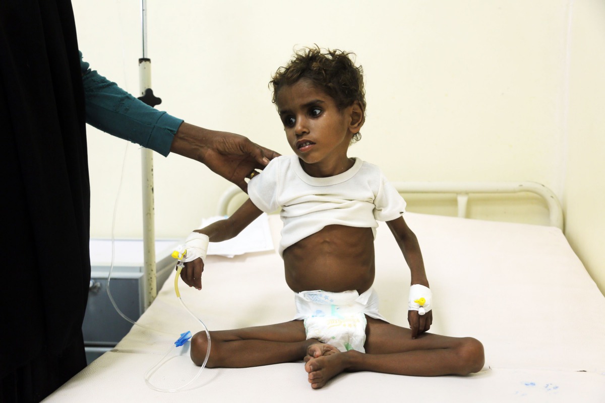 Malnourished Yemeni child receiving treatment. File photo for representational purposes only.