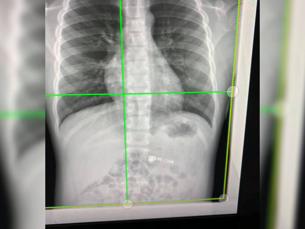 X-rays shows the wireless headphone inside the body.